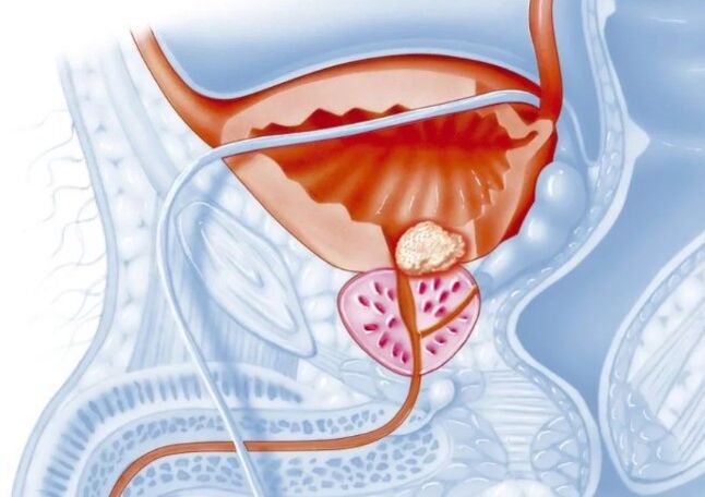 Caractéristiques de la forme chronique de la prostatite
