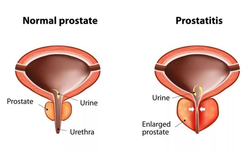 Prostate normal et enflammé