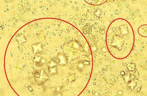 Voici à quoi ressemblent les cristaux de sel contenus dans l'urine avec une prostatite calculeuse au microscope