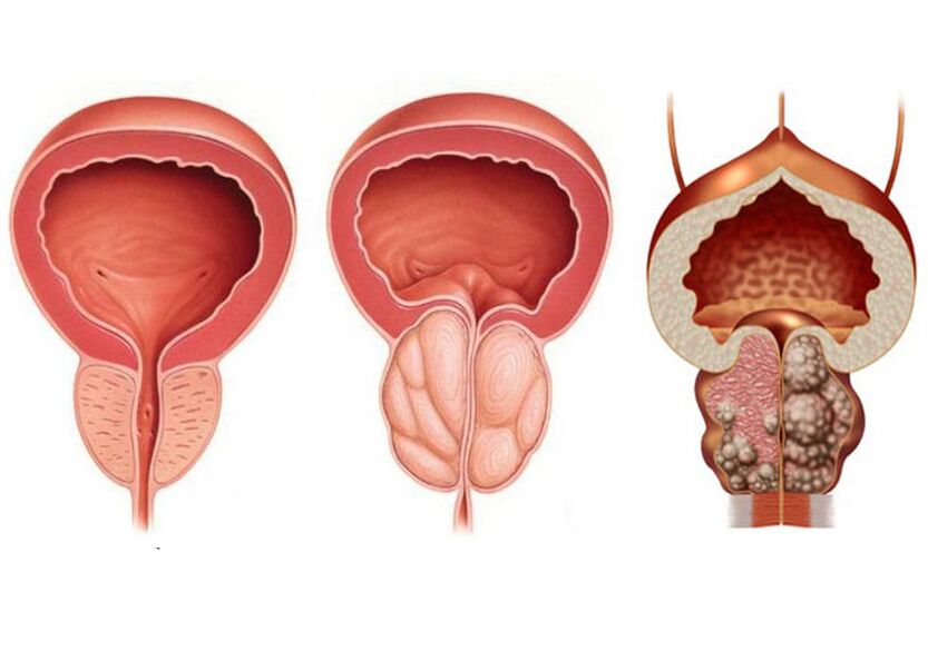 les stades de la prostatite et la nécessité d'un traitement avec Prostavit